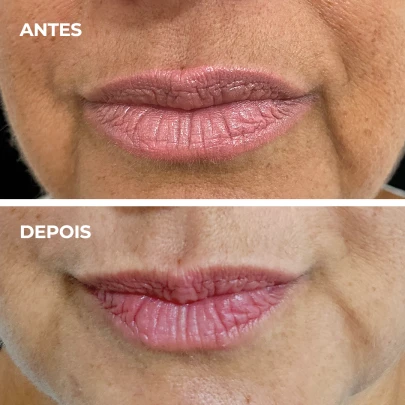 antes_e_depois_labio_1 (2)